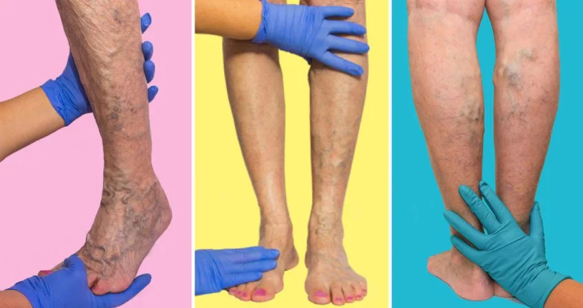 Varicose Vein